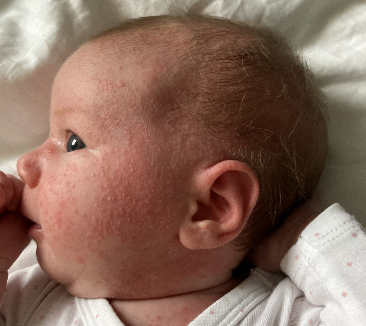 tejkiütés  babáknál seborrheás dermatitis újszülöttnél csecsemőkorban kezelése